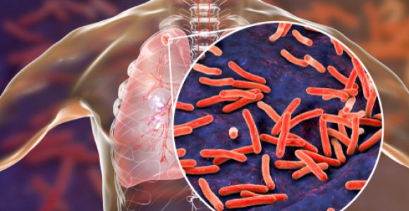 Kvėpavimo organų tuberkuliozė Nuotrauka Nr. 3