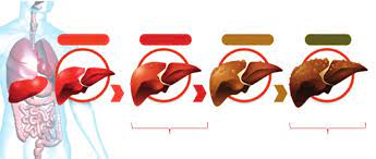 Ūminis hepatitas B Nuotrauka Nr. 1