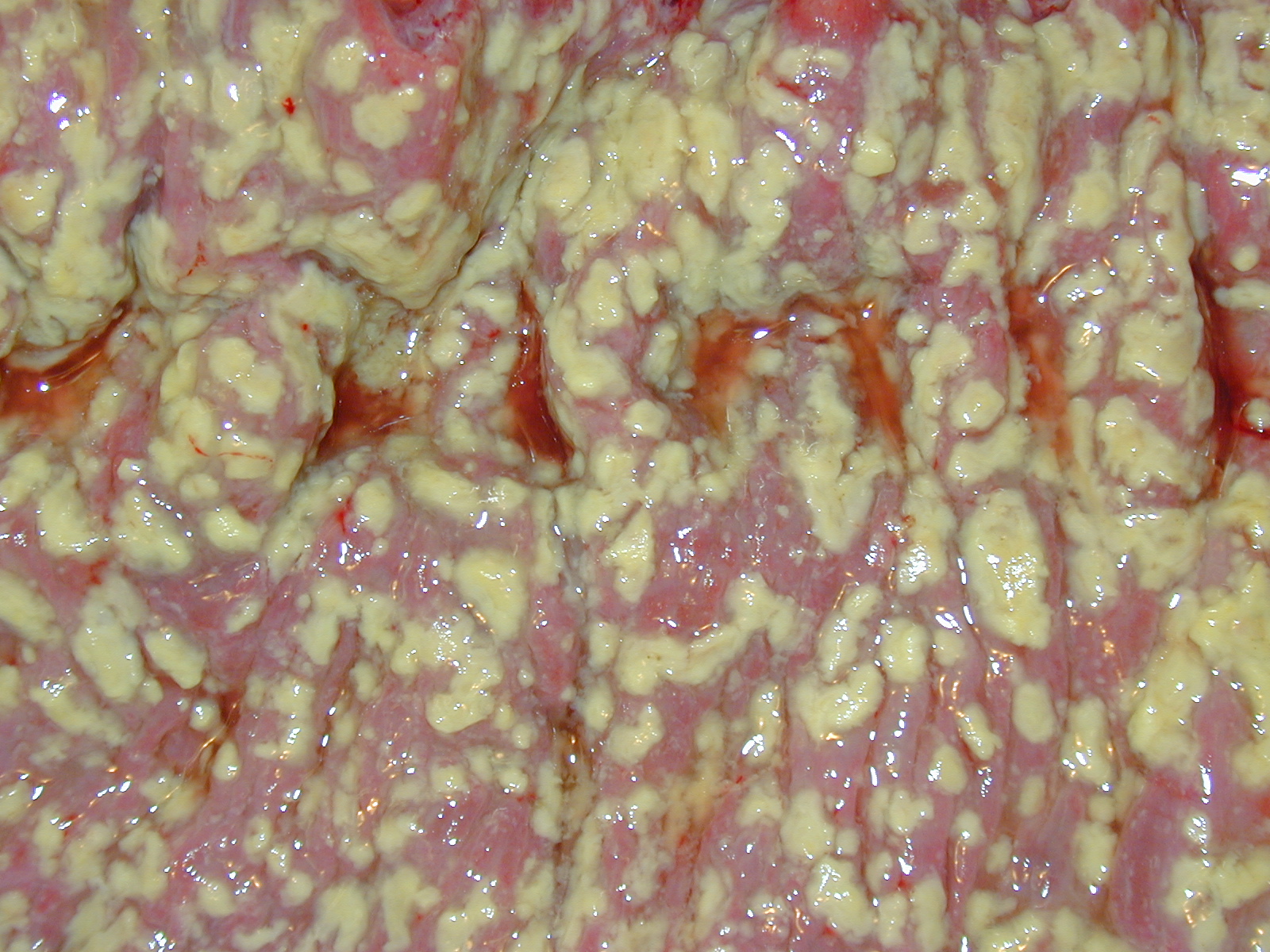 Pseudomembraninis kolitas Nuotrauka Nr. 3